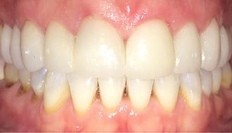 Brilliant white smile